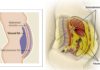 TOFI – Thin Outside Fat Inside Thin Outside Fat Inside