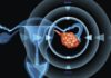 8 Early Warning Signs Of Ovarian Cancer You Shouldn’t Ignore signs and symptoms of ovarian cancer