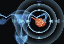 8 Early Warning Signs Of Ovarian Cancer You Shouldn’t Ignore signs and symptoms of ovarian cancer