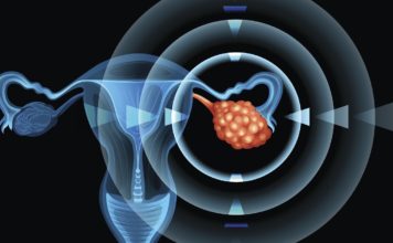 8 Early Warning Signs Of Ovarian Cancer You Shouldn’t Ignore signs and symptoms of ovarian cancer